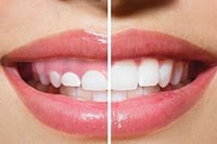 gingivectomia Estética
